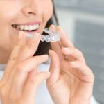 Teeth Braces - Canberra - Acacia Dental