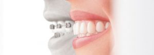 , Orthodontics: All About Adult Braces